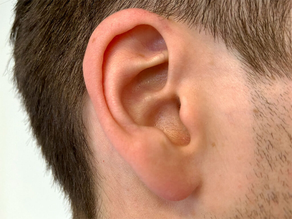Right auricle of a male patient