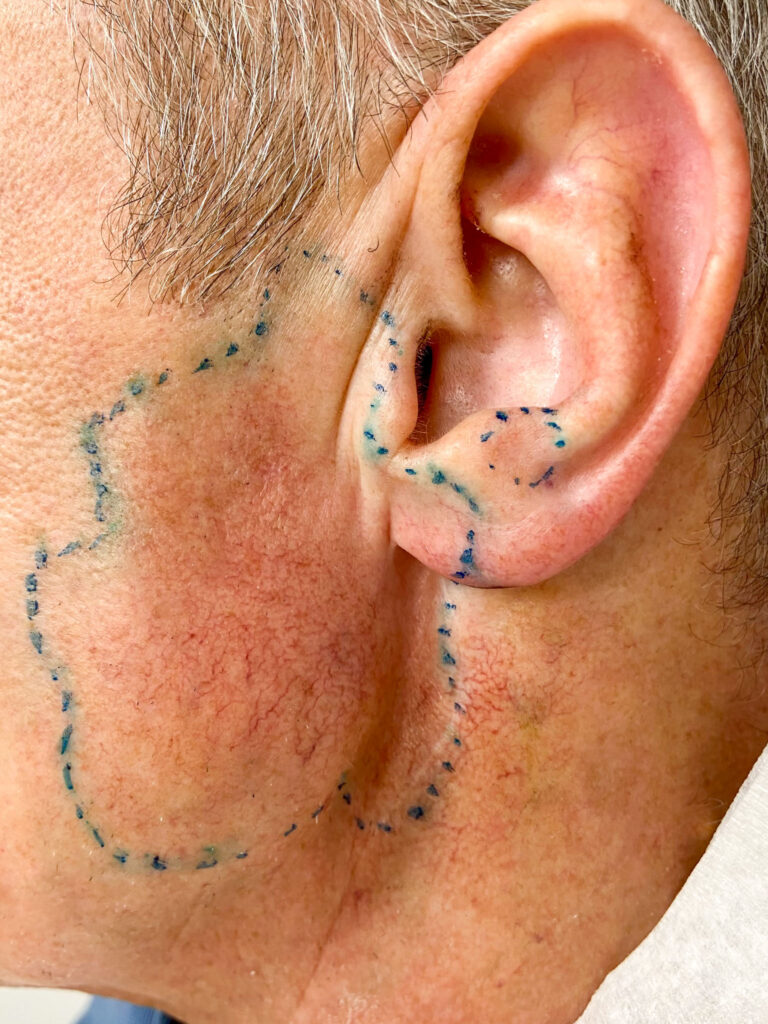 Marking of the affected area during chewing sweat before planned Botox therapy