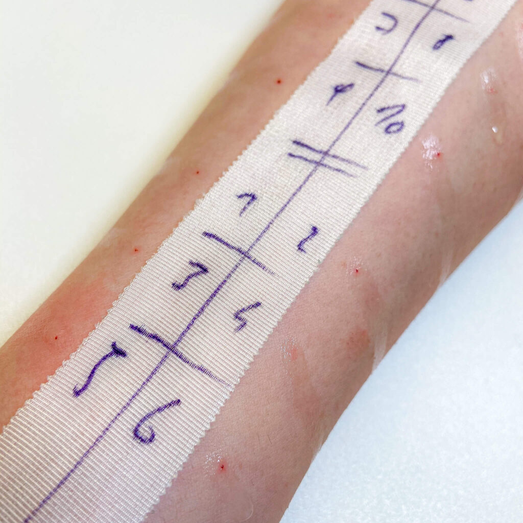 Unterarm mit aufgetropften Allergenextrakten im Rahmen eines Pricktests