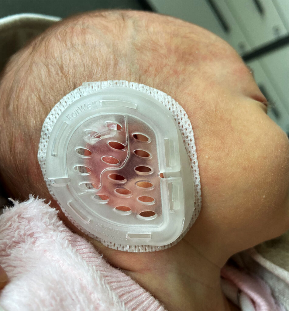 Eine EarWell-Kunststoffschiene auf einem Babyohr angebracht