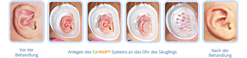 Mithilfe einer Silikonschiene von EarWell können Ohren sanft und ohne OP angelegt werden.